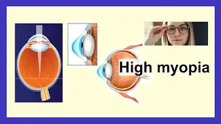 high myopia