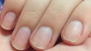 Слоятся ногти на руках