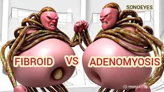Adenomyosis vs Fibroids—Know the Difference
