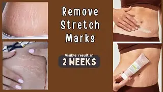 Stretch Mark Removal Cream • Pregnancy Mark • Remove Stretch Mark At Home