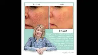 Learn with KTB, Nordlys technology - Instagram Clip - Real You Clinic