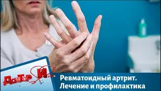 Ревматоидный артрит. Лечение и профилактика | Доктор И