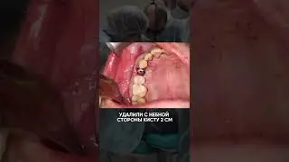 Удаляем большую кисту и одномоментно устанавливаем имплантат