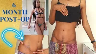 6 MONTH POST-OP| MUMMY MAKEOVER #lmarievita #tummytucksurgery | LmarieVita.com