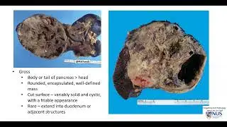Pancreas - Solid pseudopapillary neoplasm (Gross pathology)