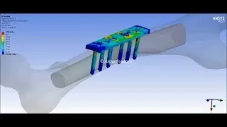 ANSYS WB Static Structural FEA - Extension, Bending and Torsion of a fractured femur with plate