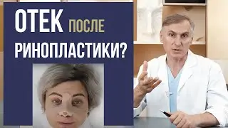 Swelling after Rhinoplasty 🤭😱 Problem❓