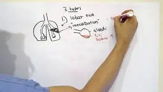 What is Pneumonia and How Do You Get It?