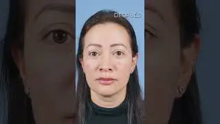 #blefaroplastia