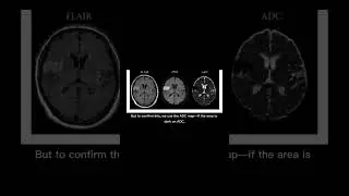What does a stroke look like on a brain?DWI and ADC sequence 