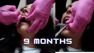 9 MONTH BRACES UPDATE (MY GAPS ARE CLOSING)