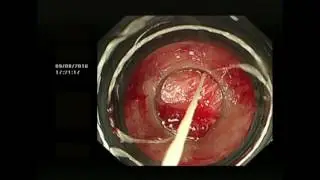 BANDING OF OESOPHAGEAL VARICES
