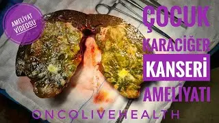 ÇOCUK KARACİĞER KANSERİ AMELİYATI |  VİDEO | profdrunalaydın