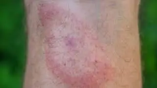 Dr. says tick illness on the rise, how to prevent Lyme Disease