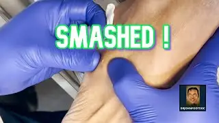 Ganglion Synovial Cyst of the foot