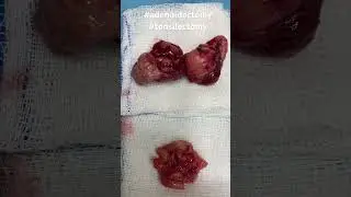 Tonsils and adenoids are often removed when they become large and inflamed.