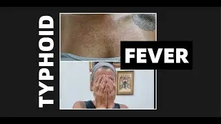 Typhoid! I thought it might be dengue but it wasn't!