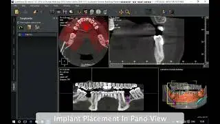 QuickVision 3D Tutorials - Create & Place an implant.
