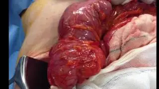 Appendiceal Neoplasm Presenting as Adult Intussusception