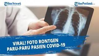 VIRAL❗ Foto Rontgen Paru-paru Pasien Covid-19 yang Divaksin dan Tidak