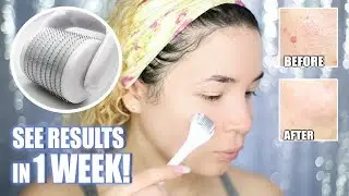 Microneedling to REMOVE ACNE SCARS!