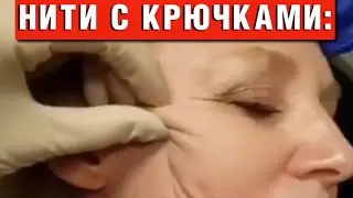 Threads with hooks under the facial skin: how cosmetologists perform lifting
