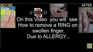HOW TO REMOVE A RING ON SWOLLEN FINGER (ALLERGIC REACTION) | PAANO ALISIN ANG SINGSING SA DALIRI DIY