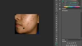 Adobe Photoshop(Sivilce Yok Etme Elimination of acne )