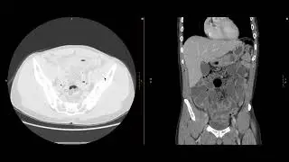 Abdominal Imaging Call Prep Cases: Perforated Appendicitis (CT) Case 2 Discussion