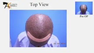5240 Grafts Body Hair Transplant Surgery Result after 1 years