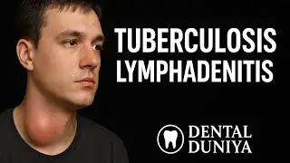 Tuberculosis Lymphadenitis | General Surgery Lecture | Simplified for BDS 3rd year | Dental Duniya