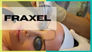 Correcting Sun Damage with Fraxel