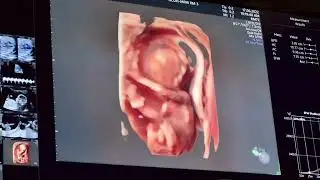 TODAY IS THE INTERNATIONAL DAY OF THE UNBORN CHILD//SPENCER AT ONLY FIFTEEN WEEKS GESTATION//