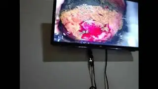 LESIONES POR VIRUS DE PAPILOMA  HUMANO   COLPOSCOPIA  Y PENEOSCOPIA    JAVIER OVIEDO.