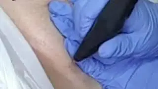 Plasma fibroblast -skin tightening by Ayelet
