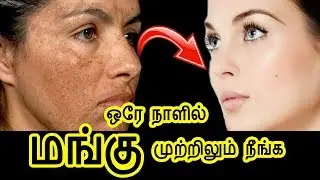 முகத்தில் உள்ள மங்கு உடனடியாக போக | How to cure Melasma/Pigmentation | How to cure mangu in Tamil