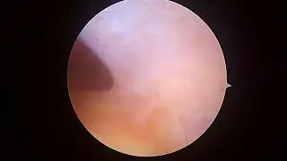 L knee loose body removal, patellofemoal OCD 3 23 23 GB