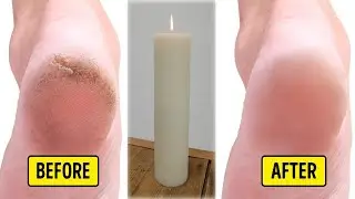 Candle for Cracked Heels Treatment in 5 Minutes The Ultimate Remedy
