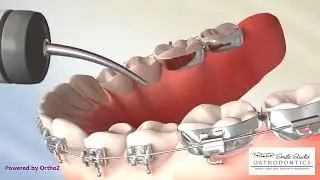 Buildups Molar