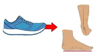 Why shoes cause Flat Feet 