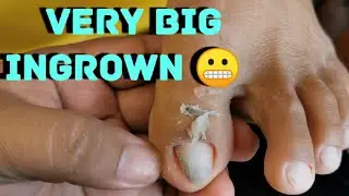 REMOVING INGROWN AND DEADSKIN with care P2 | Ingrown Queen Vlogs #ingrown