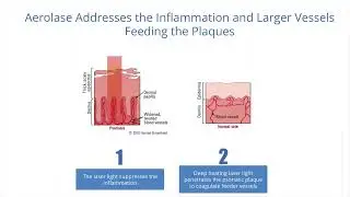 Psoriasis Quicker Clearance with Aerolase Laser | Available at LaserSkin.ca