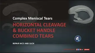 Understanding Complex Meniscal Tears 🦵