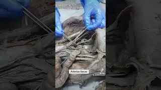 Las arterias iliacas externa e interna
