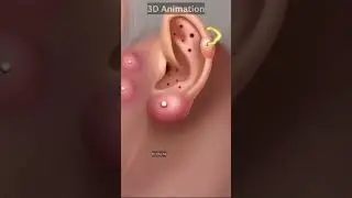 3D Animation Ear Infection Treatment #infection #health #beauty #facebeauty #shorts