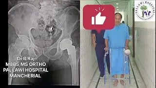 Patient Walking immediately after hip fracture surgery #mancherial #orthopaedicsurgeon #trending