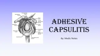 Adhesive capsulitis - pathophysiology, clinical presentation, imaging, treatment, complication