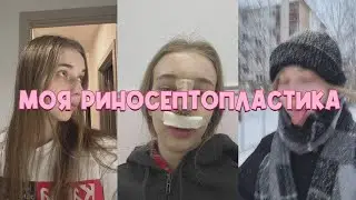 Риносептопластика моя история. Доктор Акопов Арам Артурович