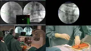 RIWOtrack electromagnetic spinal navigation for full-endoscopic spine surgery