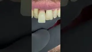 Patient wants lighter color than adjacent tooth!